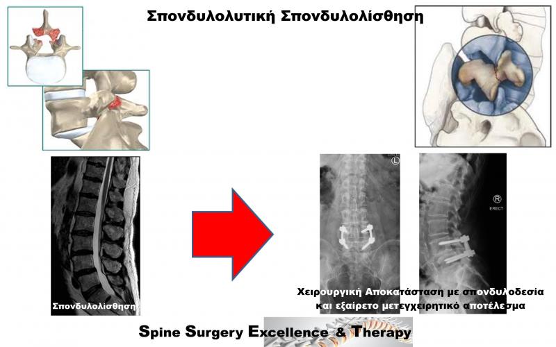 Lytic Spondylo